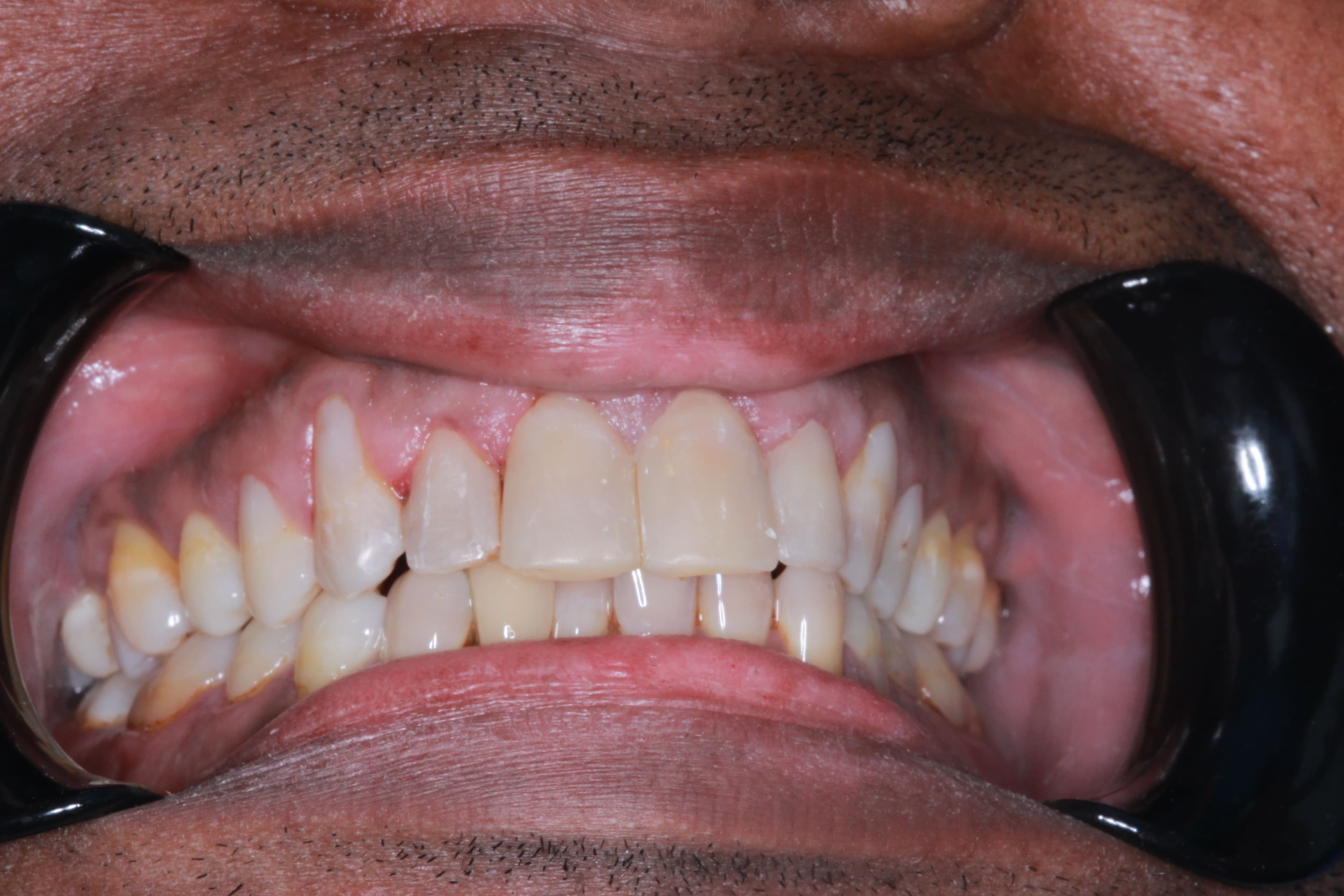 Successful composite bonding after photo