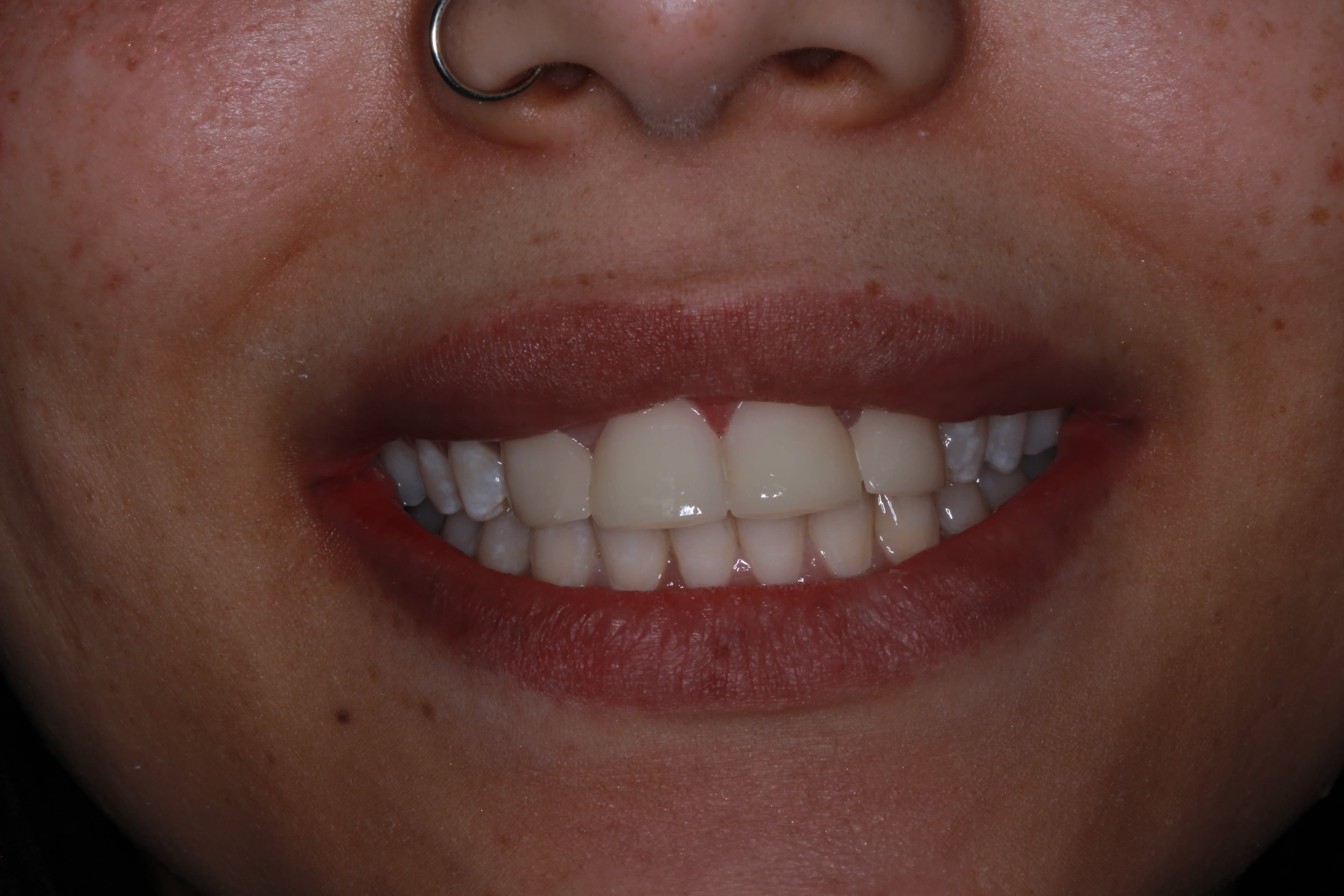 Successful composite bonding after photo