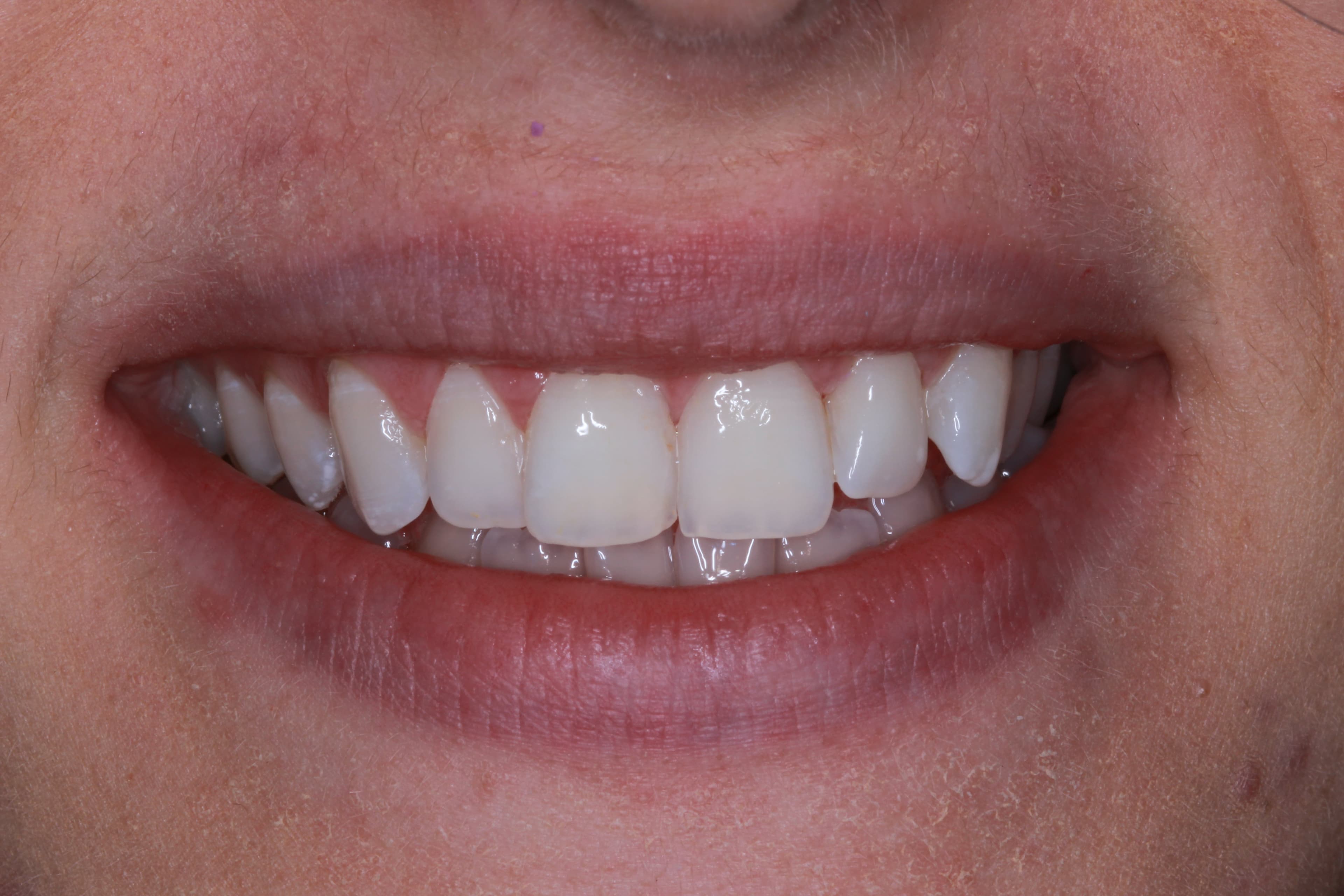 White spot removal and whitening after photo